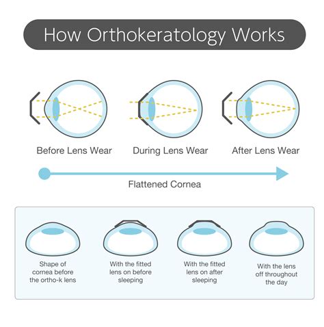 orthokeratology bondi